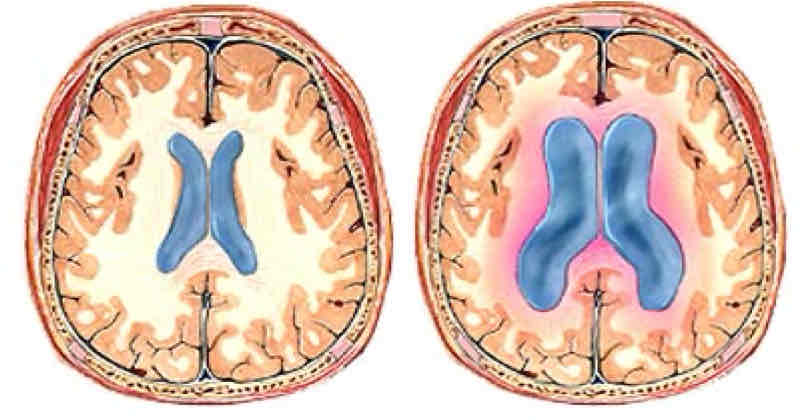 <p>Which brain is considered hydrocephalic? How can you tell?</p>