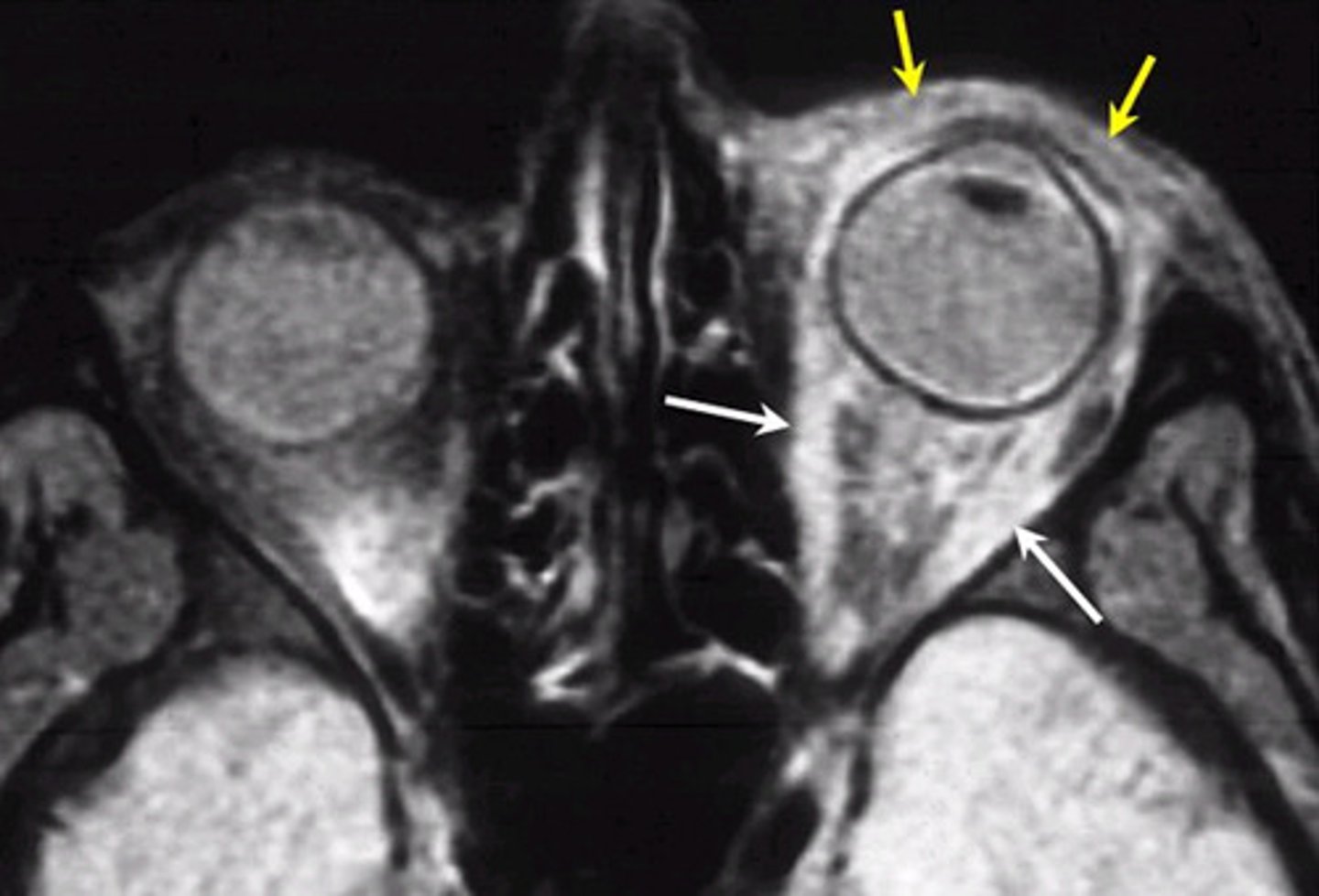 <p>Emergency department will perform a CT scan of the orbits and paranasal sinuses (axial and coronal with contrast) to confirm diagnosis</p><p>Admit/refer to ED/hospital for IV antibiotics stat</p><p>(Concern for infection of the CNS and meningitis- refer immediately to emergency department)</p>