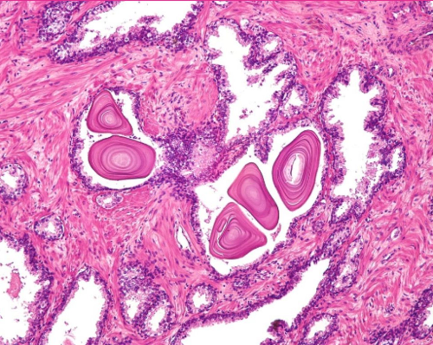 <p>What extracellular accumulation?</p>