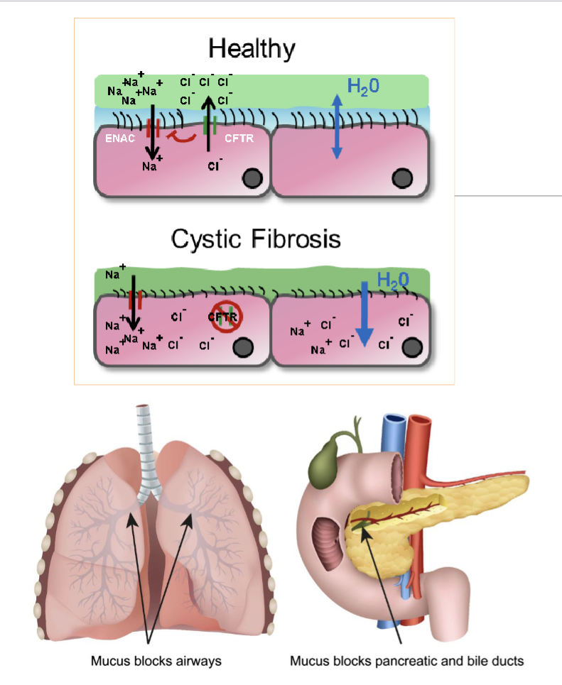 <ul><li><p>Autosomal recessive genetic disorder by co-inheriting 2 mutatn allels of the CFTR gene on chromosome 7</p></li><li><p>Cystic fibrosis transmembrane conductance regulator(CFTR) is an ion channel that transport Chloride ions into surface lumens in airways within lungs, pancreas, and GI</p></li><li><p>Movement of Chloride into extracellular space creates an osmotic gradient to ensure mucus in lumen has adequate water content to reduce viscosity and improve mobility of mucus</p></li><li><p>In Cystic fibrosis loss of CFTR ion channel lead to thickened mucus, leading to poor lung function due to mucus buildup, pancreatitis, and decreased absorption of fats, carbs, and protein</p><ul><li><p>patients need extra pancreatic enzyme oral supplements(pancreases) with meals to aid digestion</p></li></ul></li></ul><p></p>