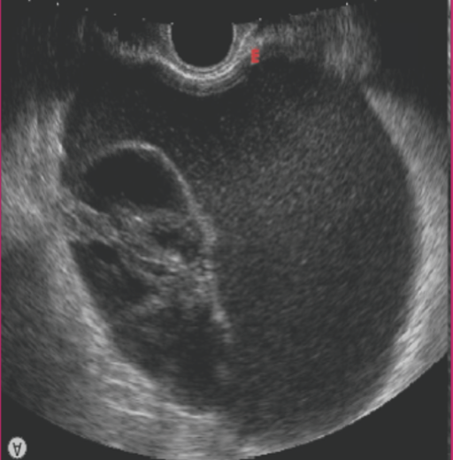 <p>Mucinous cystadenoma is a benign tumor lined by the mucinous elements of the ______ and ______</p>