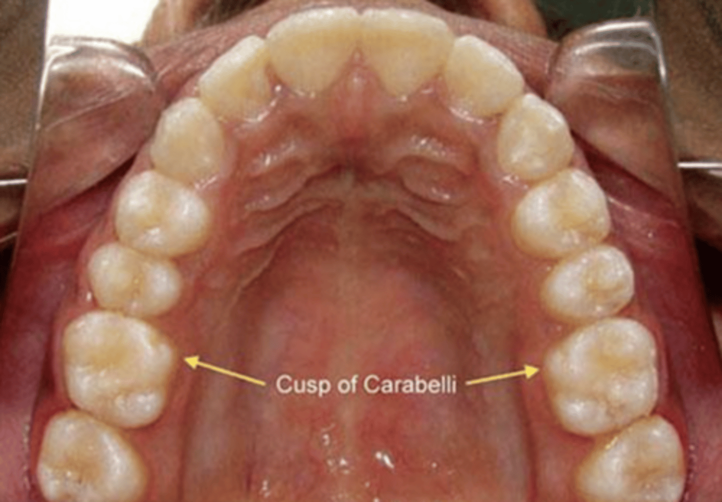 <p>5th nonfunctioning cusp</p><p>commonly arising from the lingual surface of the ML cusp of the max 1st molar</p>