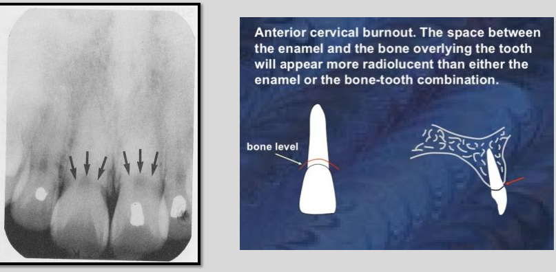 <ul><li><p>Appears as a collar or ill-defined wedge shaped radiolucency on the mesial and distal root surfaces near CEJ</p><ul><li><p>May confuse with root caries&nbsp;</p></li></ul></li><li><p>Artifact results from difference in densities of adjacent tissues </p></li></ul><p></p>