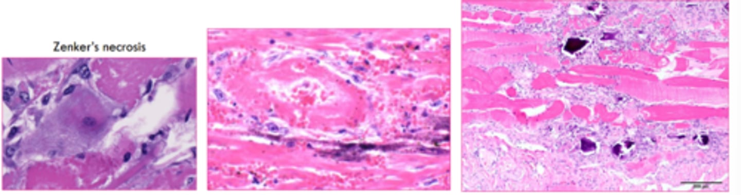 <p>initially basophilic stippling in mitochondria which progresses to whole cell and extracellular tissue</p>