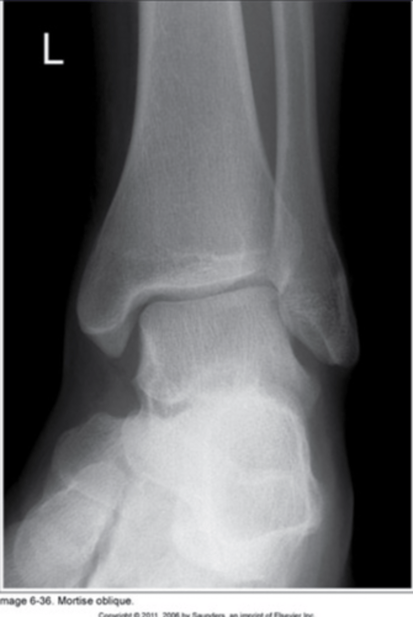 <p>Under rotated</p>