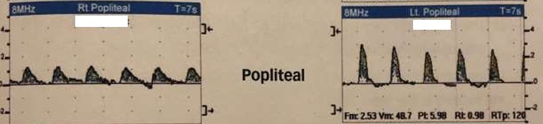 <p>What do the popliteal artery waveforms most likely represent? </p><ul><li><p>Describe L &amp; R waveforms</p><ul><li><p>If diseased, where disease is located and if it is inflow/outflow disease</p></li></ul></li></ul><p></p>
