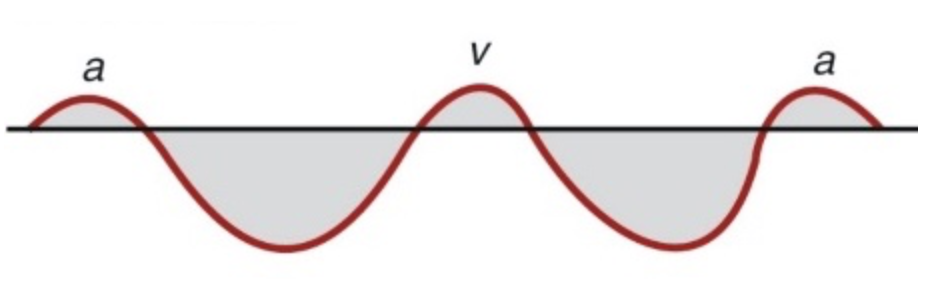 <p><span><span>The following image represents the Doppler flow pattern for</span></span></p>
