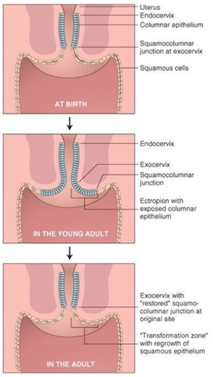 <p>Area near the ectocervix where columnar cells undergo metaplasia / become squamous</p>