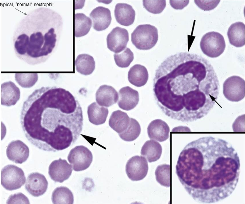 <p><span style="font-family: Lato Extended, Lato, Helvetica Neue, Helvetica, Arial, sans-serif">All of the following characteristics of "toxic" changes to neutrophils apply EXCEPT for ___________________.</span></p>