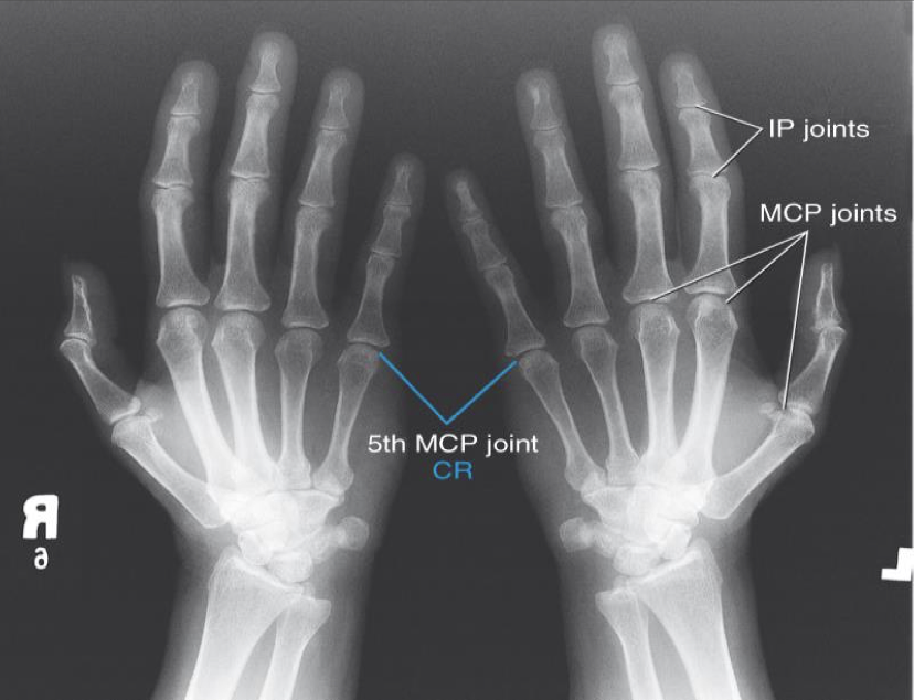 <p><span style="line-height: normal;">• </span>Bilateral hands in 45° oblique position</p><p class="p1"><span style="line-height: normal;">• </span>Midshafts of second to fifth metacarpals and base of phalanges not overlapped</p><p class="p1"><span style="line-height: normal;">• </span>Thumb not superimposed over metacarpals</p><p class="p1"><span style="line-height: normal;">• </span>MCP joints should open</p>
