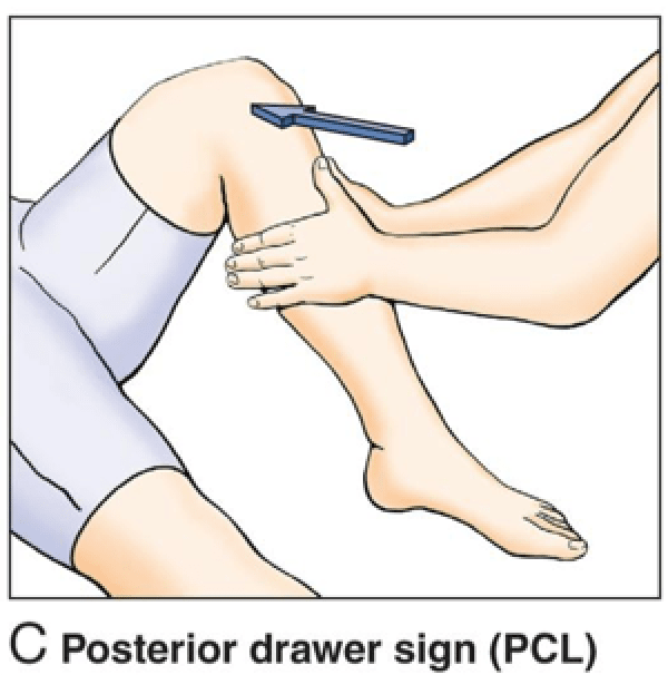 <ol><li><p>Patienten ligger med knäet böjt till ca 90°</p></li><li><p>Undersökaren sitter på patientens fot för att stabilisera den</p></li><li><p>Placera båda händerna runt tibia, precis under knäet, med tummarna på tuberositas tibiae</p></li><li><p>Tryck tibia bakåt i en snabb men kontrollerad rörelse</p></li><li><p>Notera rörelseomfång och end-feel</p></li><li><p>Jämför tibias rörelse ned det andra knäet</p></li></ol><p><strong>Vid ökad förskjutning dorsalt misstänks ruptur av bakre korsbandet</strong></p>