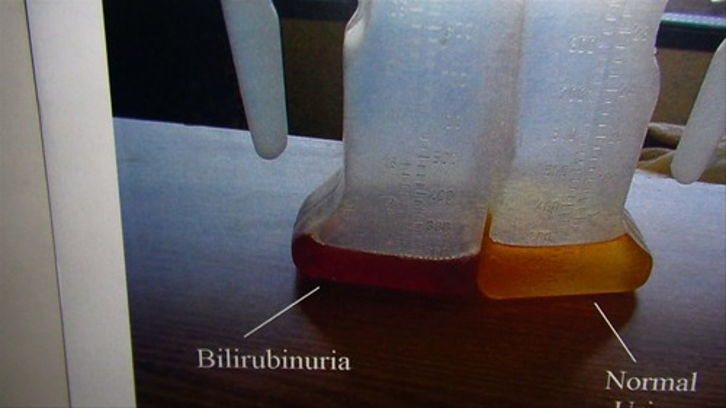 <p>The presence of bilirubin in the urine.</p>