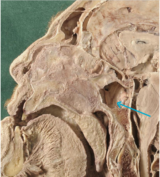 <p>which sinus?</p>