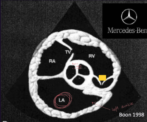 <p>Right Parasternal Short Axis View&nbsp;</p>