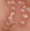 <p>• Grouped fluid-filled vesicles on an erythematous base</p><p>• Small, painful</p><p>• Can reactivate</p>