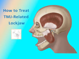 <p>Lock jaw</p>