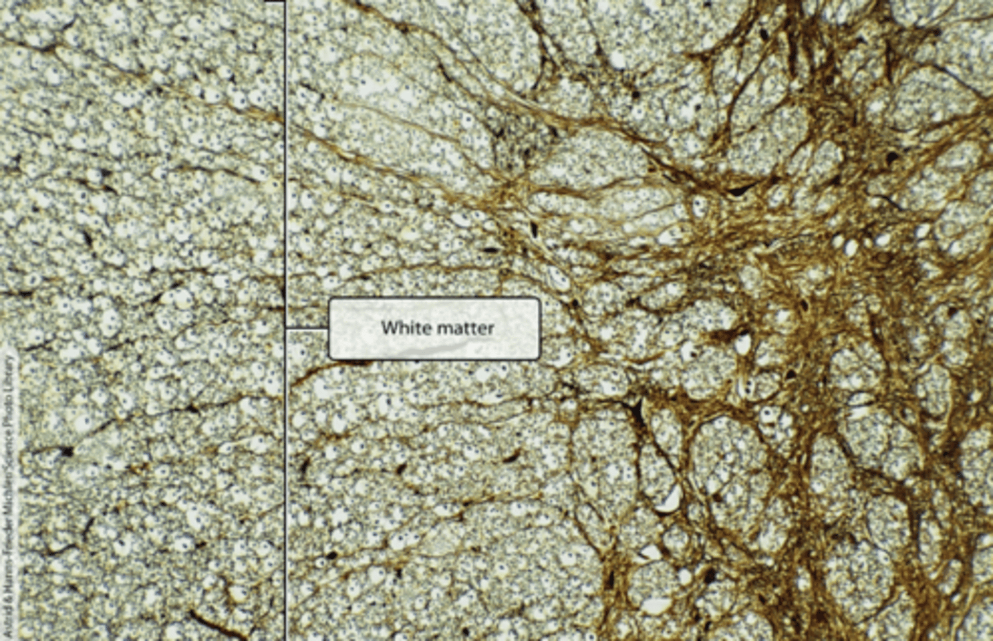 <p>Histology of white matter</p><p>forms the superficial part of the spinal cord and is composed of both myelinated and unmyelinated axons that travel in ascending and descending fiber tracts. </p><p>Appears white because of the abundance of lipid-rich myelin that surrounds and insulates most axons, facilitating rapid signal conduction</p><p>Ascending axons carry sensory signals up the spinal cord toward the brain. Descending axons carry motor signals down the spinal cord toward the periphery. </p><p>Commissural fibers: axons that cross the spinal cord. </p>