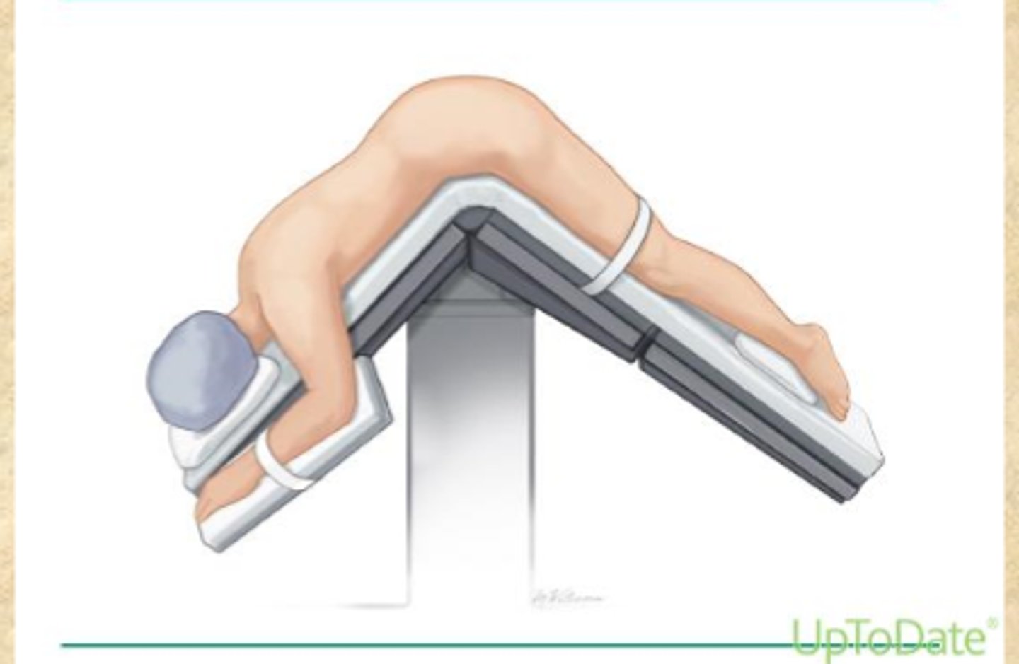 <p>-knee-chest position (LLD, child's pose)</p><p>-prone jackknife position (for surgical purposes)</p>