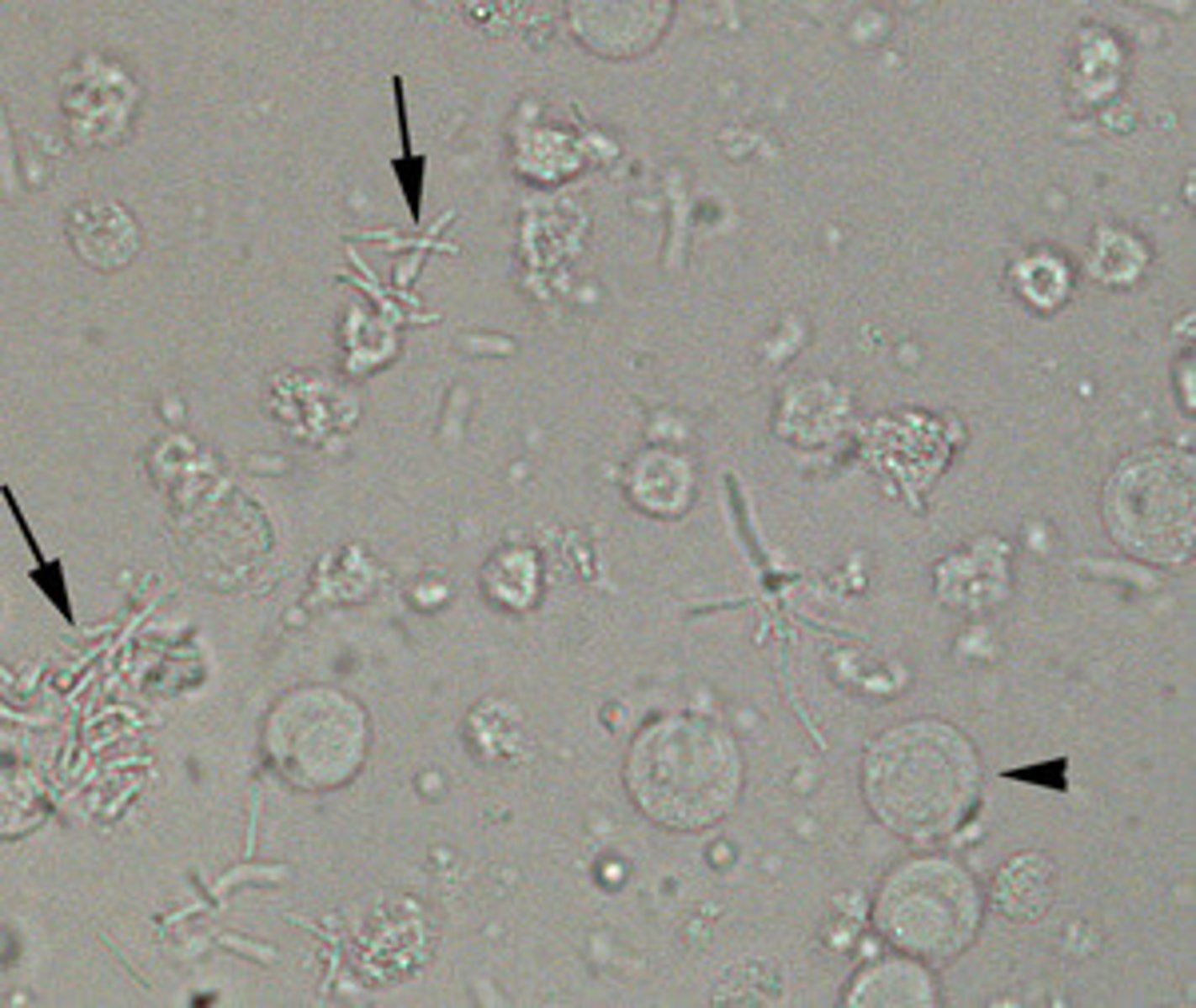 <p>Bacteria are normally not present in the urine, but a few can occur as result of vaginal, urethral or external genitalia contamination of the collection container.</p><p>- To be clinically significant for a UTI the bacteria MUST be accompanied by WBCs.</p><p>- Observing them for motility is also a good way to distinguish them from other amorphous phosphates and urates.</p><p>UTIs: Most frequent culprits</p><p>- Enterobacteriaceae (gram-negative rods)</p><p>- Staphylococcus and Enterococcus are also possible but less likely</p>