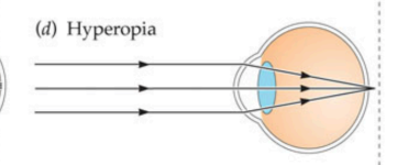 <ul><li><p>farsightedness → close objects are blurry, far objects are clear</p></li><li><p>light focuses behind retina</p></li></ul><p></p>