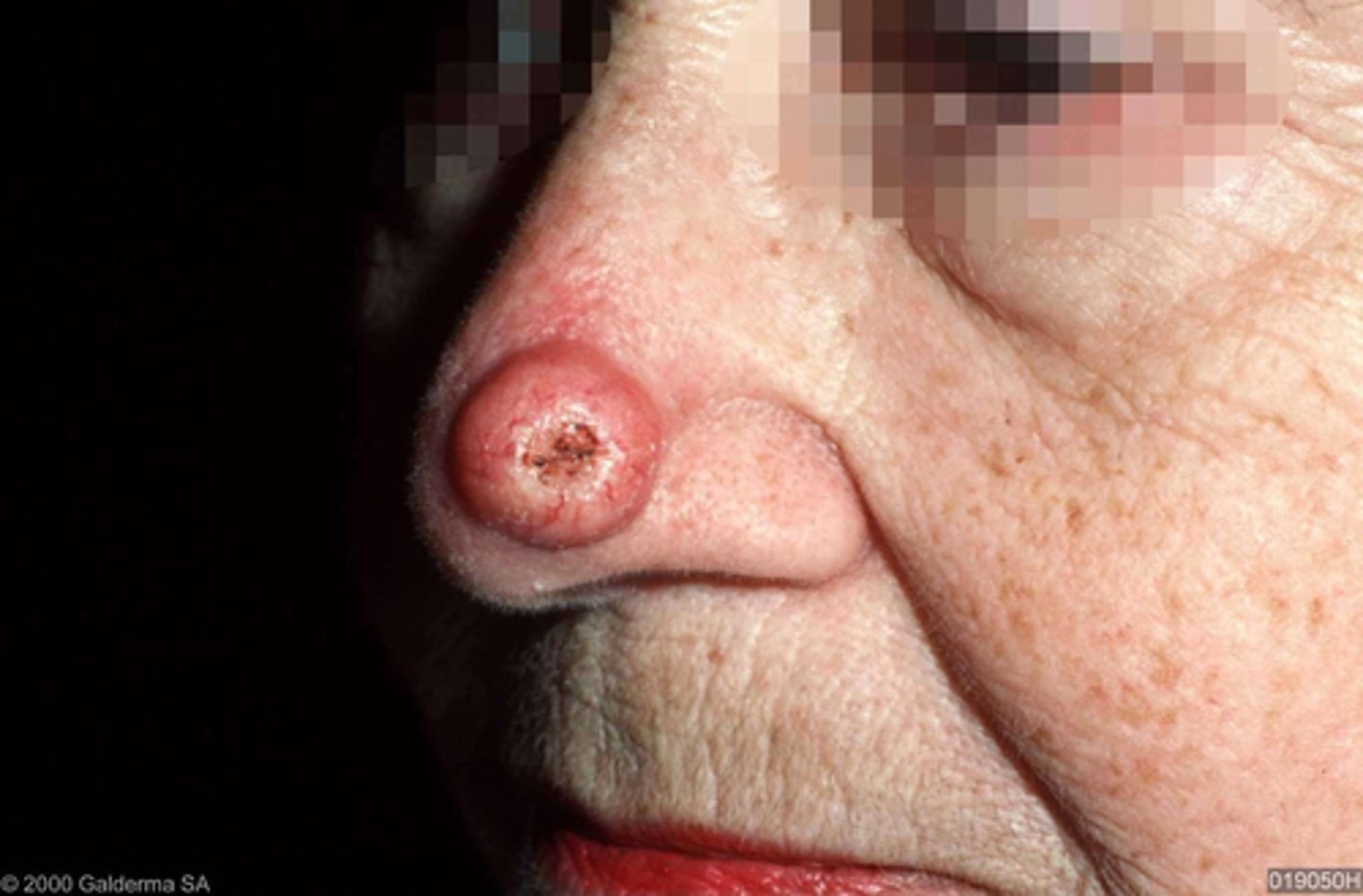 <p>= maligne huidttumor</p><p>~ pompoen</p>