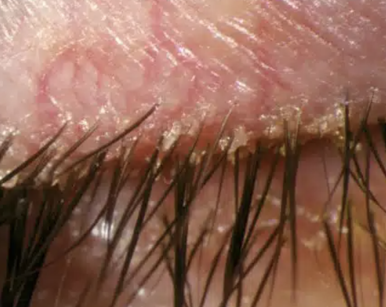 <p>Abnormal Findings for <strong><em>5. Redness, swelling, discharge, or lesions</em></strong></p><ul><li><p>Redness and crusting along the lid margins</p></li><li><p>Infection caused by Staphylococcus Aureus</p></li></ul><p></p>