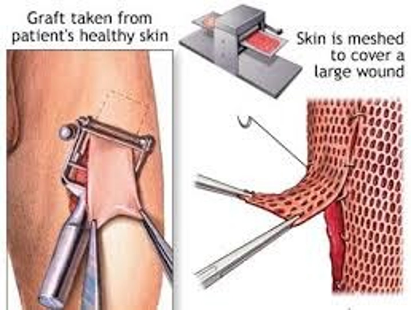 <p>meshed or non-meshed</p><p>- meshed = machine puts holes in skin to allow it to stretch over wound.</p><p>- non-meshed = no holes</p>