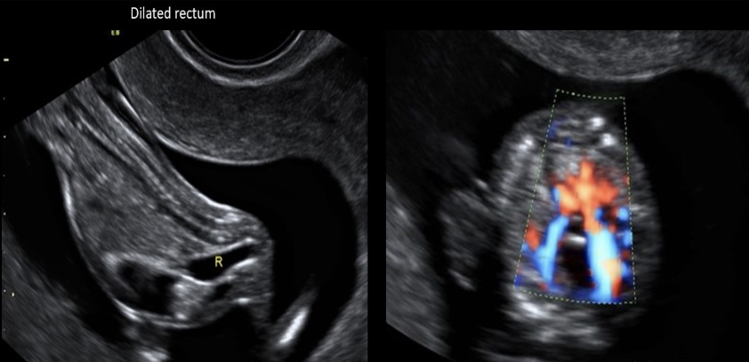 <p>a <strong>dilated fetal rectum</strong> should raise strong suspicion of</p><p>a) posterior urethral valves</p><p>b) cystic fibrosis</p><p>c) anal atresia</p><p>d) jejunal atresia</p>