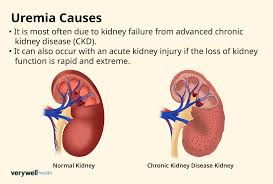 <p><strong>Which of the following clinical manifestations would lead the nurse to suspect the renal failure patient is developing uremia? Select all that apply.</strong></p><p>A) Weakness and fatigue</p><p>B) Lethargy and confusion</p><p>C) Extreme itching</p><p>D) Blood in urine</p><p>E) Urine smell in the stool </p>