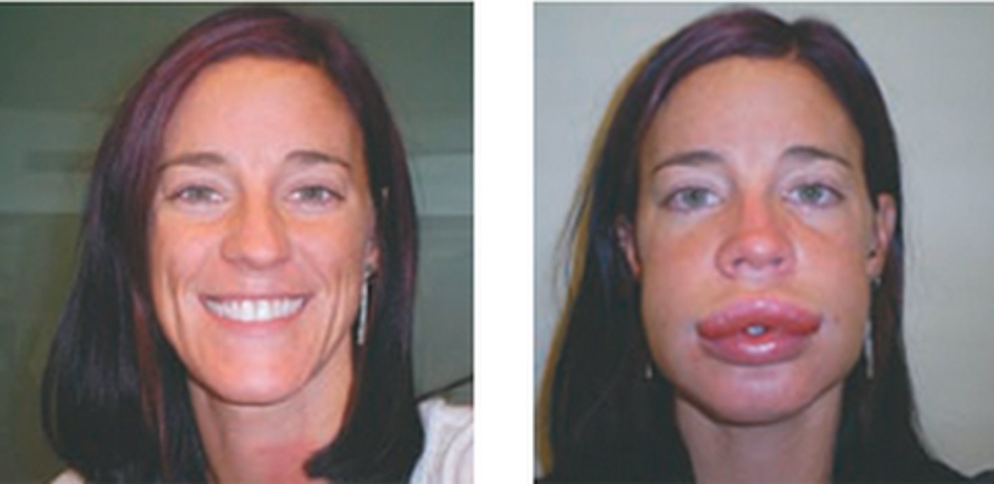 <p>localized areas of swelling beneath the skin, often around the eyes and lips, but it can also involve other body areas as well</p>