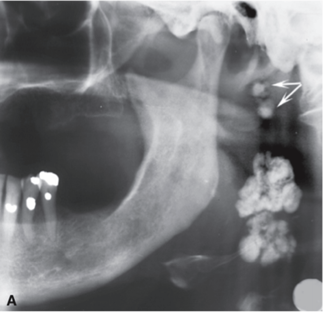 <p>Cauliflower shape</p>