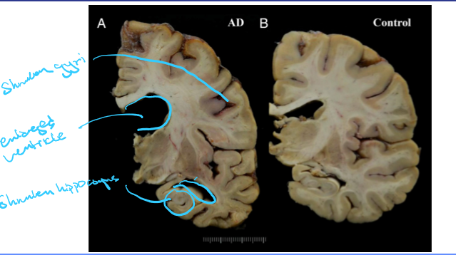 <p>Shrunken gyri</p><p>Enlarged ventricle</p><p>Shrunken hippocampus</p>