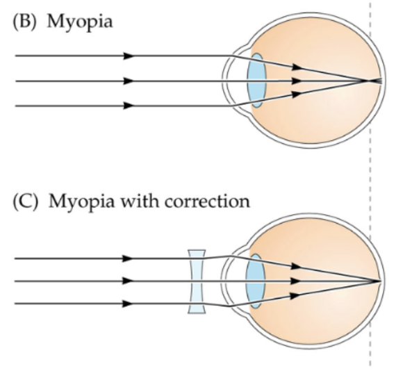 <p><span style="background-color: transparent; font-family: &quot;Times New Roman&quot;, serif;"><strong><span>Nearsightedness,</span></strong><span> eyeball too long or optics too strong, distant objects in focus in front of retina</span></span></p><ul><li><p><span style="background-color: transparent; font-family: &quot;Times New Roman&quot;, serif;"><span>tends to run in families (genetic)</span></span></p></li><li><p><span style="background-color: transparent; font-family: &quot;Times New Roman&quot;, serif;"><span>incidence is increasing due to environmental factors</span></span></p></li><li><p><span style="background-color: transparent; font-family: &quot;Times New Roman&quot;, serif;"><span>near-work (e.g. reading) especially under low illumination causes eyeball to continue to grow</span></span></p></li><li><p><strong><u>Need concaved lens</u></strong></p></li></ul><p></p>