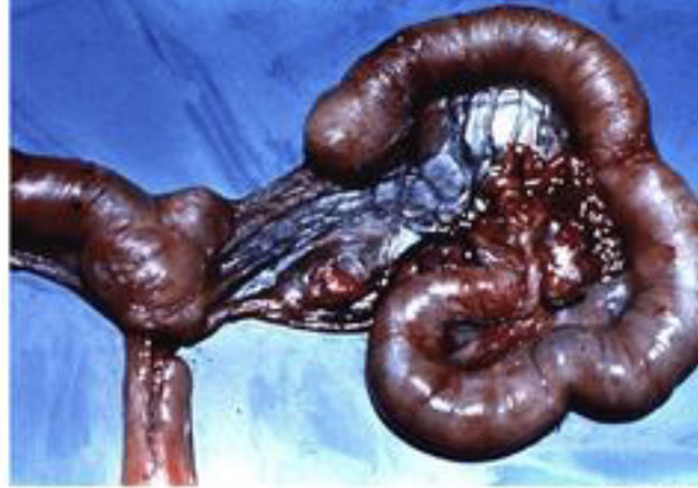 <p>What is the best term for the distribution of this lesion?</p><p>A. Focal</p><p>B. Segmental</p><p>C. Multifocal to coalescing</p><p>D. Disseminated</p><p>E. Diffuse</p>