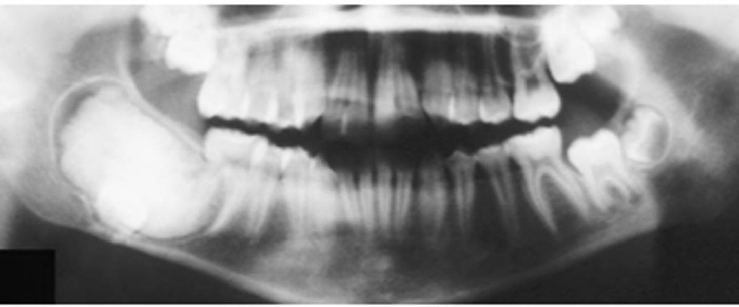 <p>radiopaque mass</p>