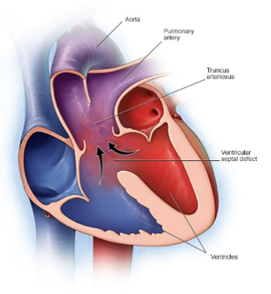 <p>pulmonary artery and aorta do not separate so one main vessel receives blood from RV and LV, large VSD mixed blood in RV and LV, mixed cyanosis, increases pulmonary resistance, VSD is only reason for life, needs surgical correction</p>