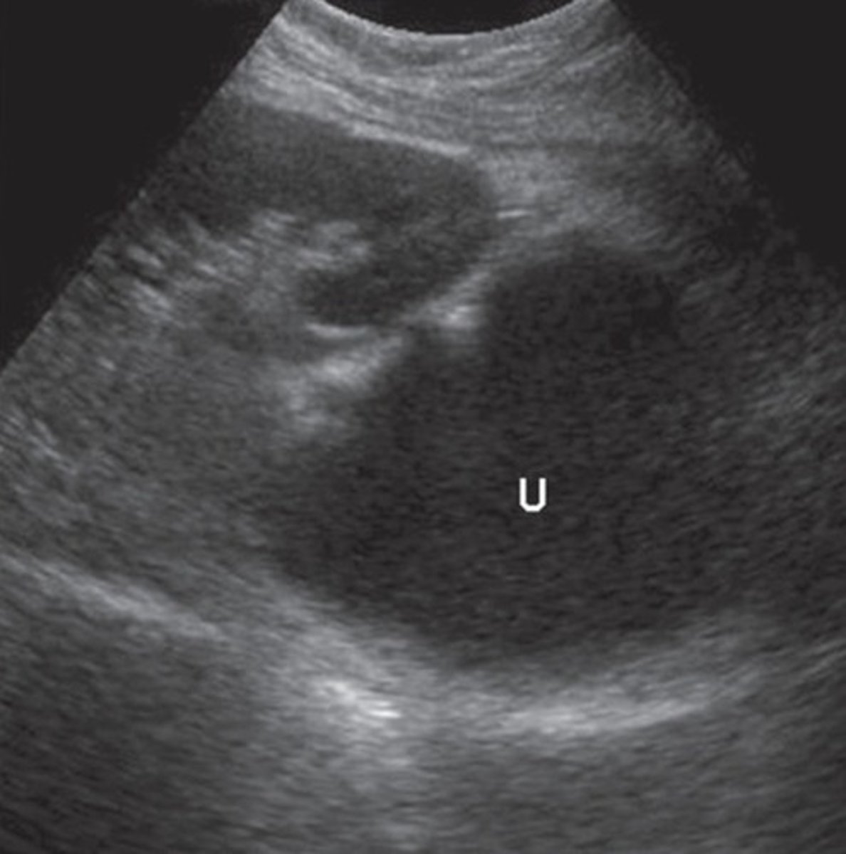 <p>Urine leaking from ureteral anastomosis</p><p>Seen in first weeks post-transplant</p><p>Suspected when urine output decreases</p><p>Risk for rupture - increase quickly</p>