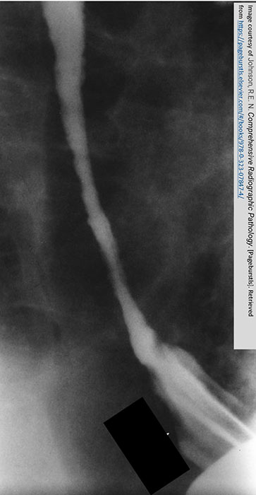 <p>What is the late-stage radiographic appearance of GERD?</p>