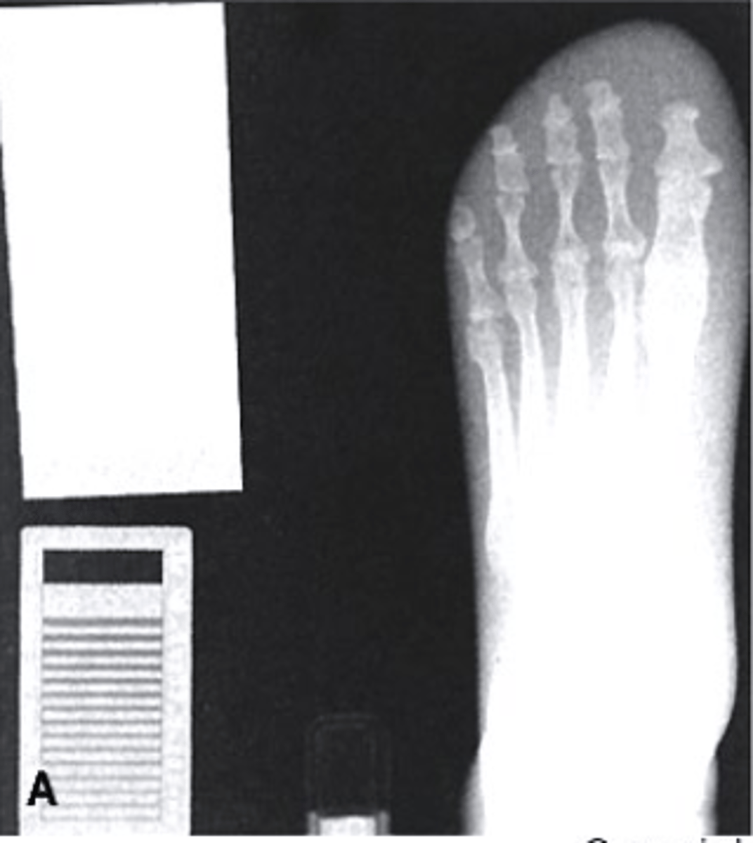 <p>Which of the following would be used to describe this radiograph?</p><p>a. Underexposed</p><p>b. Correctly Exposed</p><p>c. Overexposed</p>
