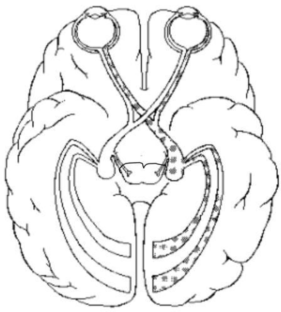 <p>Partial crossover of fibers from the nasal aspect of each retina.</p>