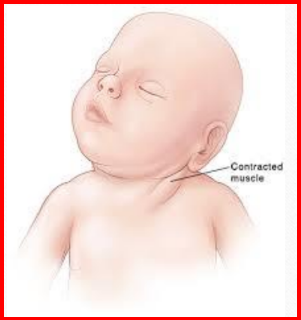 <p>Câu 57: Cơ nào bị <span style="color: red;">co rút gây ra </span><span style="color: yellow;">tật vẹo cổ</span> (<span style="color: rgb(15, 190, 219);">Torticollis</span>)?<span>&nbsp;</span></p><p class="MsoNormal">A. Cơ<span style="color: green;"> Ức đòn chũm</span><span style="font-family: "Segoe UI Symbol", sans-serif;"><span>✓</span></span><span>&nbsp;</span></p><p class="MsoNormal">B. Cơ thang<span>&nbsp;</span></p><p class="MsoNormal">C. Cơ delta<span>&nbsp;</span></p><p class="MsoNormal">D. Cơ ngực lớn<span>&nbsp;</span></p>