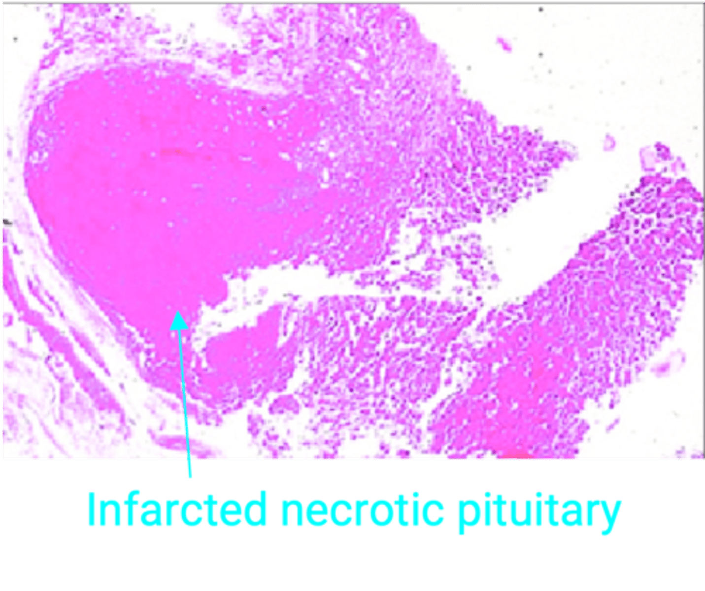 <p>Define Cause of Hypopituitarism:</p><p>Postpartum ischemic necrosis of Anterior Pituitary</p><p>-Path: During pregnancy, ↑size and ↑number of PRL secreting cells -&gt; ant. pituitary enlargement, but blood supply doesn’t increase proportionately -&gt; ant. pituitary is vulnerable to infarction due to hypovolemic shock</p><p>-Sx/PE</p><p>&gt; Postpartum hemorrhage/blood loss</p><p>&gt; Pituitary infarction -&gt; hypopituitarism</p>