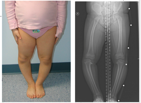 <p>What is the pathology present in the patient’s right leg? </p><p>How would you design an orthosis to treat this condition?</p>