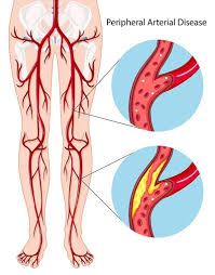 <p>Pain in lower legs and stasis ulcers (open sores)</p>