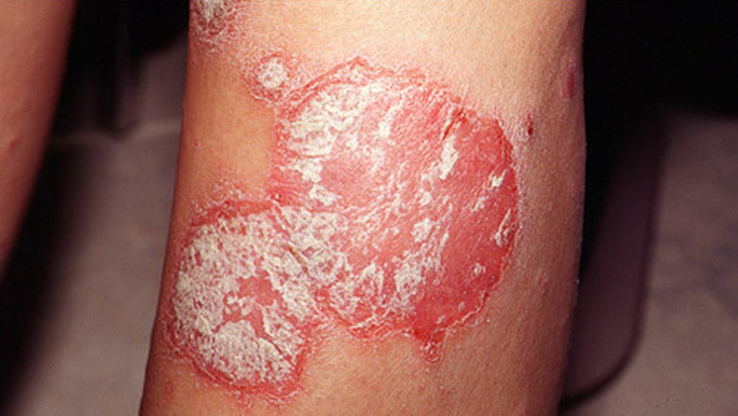 <p>chronic skin condition producing red lesions covered with silvery scales</p>