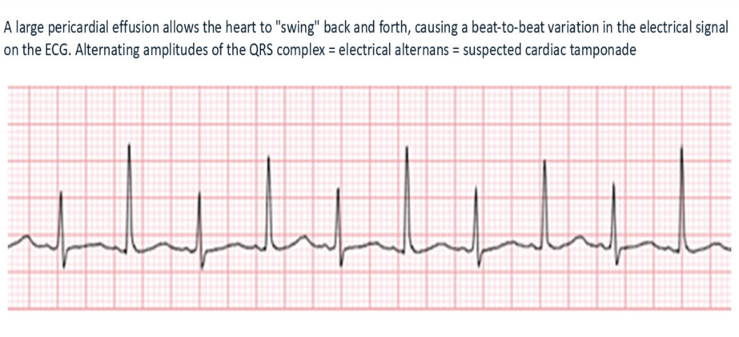 <p>Electrical alternans is a common finding with? </p>
