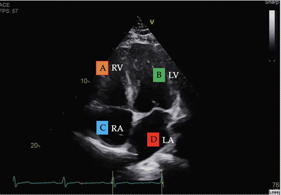 <p>Apical 4 chamber</p>
