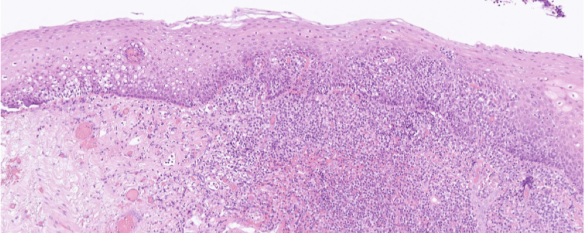 <p>Tonsillerna har <strong>skivepitel</strong>, det enda lymfoida organet med skivepitel. Finns ett lager med basalceller längst in.</p>