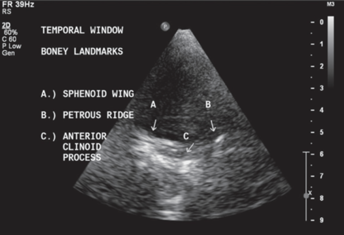 <p>Sphenoid</p><p>Petrous ridge</p><p>Anterior clinoid process</p>