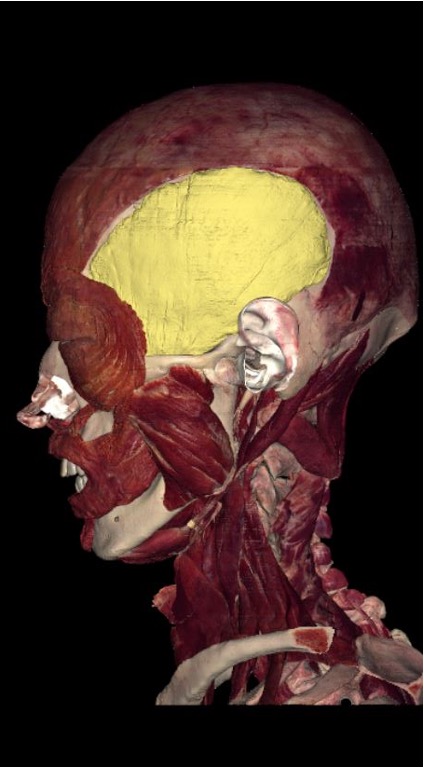 <p>origin: floor of temporal fossa</p><p>insertion: coronoid process of mandible</p><p>innervation: CN V (trigeminal mandibular division)</p><p>action: elevate and retract mandible</p>